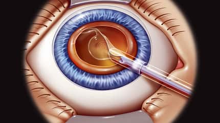 artificial implant,artificial lens,artwork,eye,eye surgery,human,implant,intraocular lens,lens,medicine,multifocal,ophthalmology,plain background,presbyopia,refractive surgery,sight,surgery,treatment Intraocular Lens