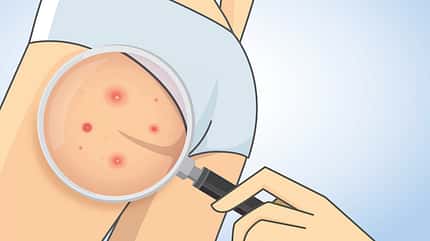 Body Care,Vector,Beauty Treatment,Women,Females,Zoom,Illustration,Great Red Spot,Panties,Cartoon,Acne,Buttocks,Looking,Finding,Holding,Removing,Hygiene,Human Skin,Problems,White,Part Of,Healthcare And Medicine,Close-up,Rear View,Hip,Human Leg,Human Hand,Pimple,Naked,People,Magnifying Glass,Bikini,Underwear,skin disease,Body Part Zoom in acne on buttocks with magnifier
