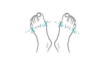Grafik zweier Füße mit Markierungen an den Zehengelenken