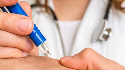 borreliosis Doctor removing a tick with tweezers from hand of patient